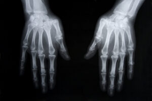 rentgen dłoni